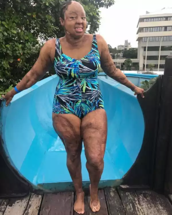 Sosoliso Plane Crash Survivor & Singer, Kechi Shares Pix Showing Her Body In Swimwear